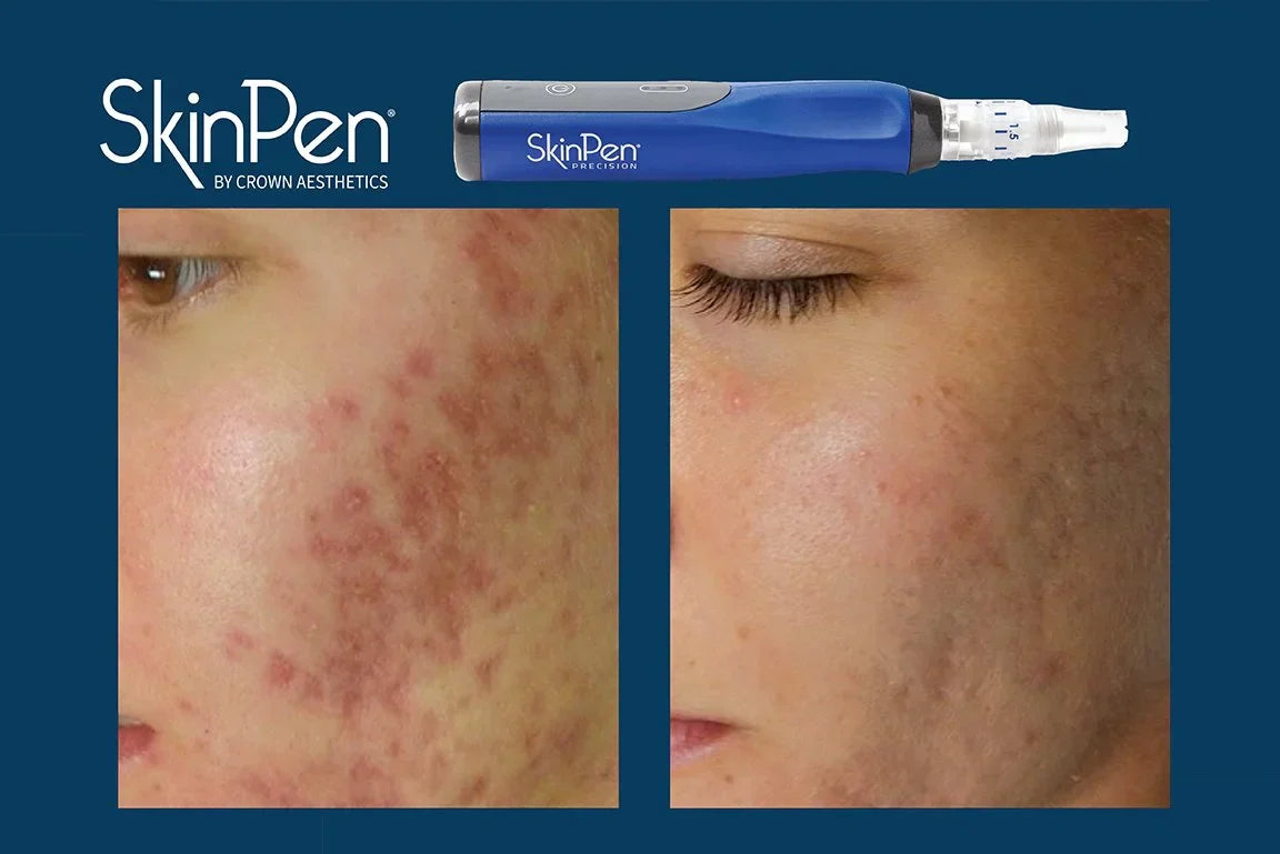 SkinPen - Meine persönliche Erfahrung